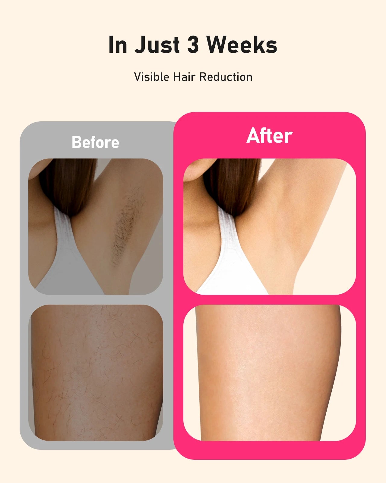 IPL Laser Hair Removal Device - 999,900+ Flashes, 22J Power, 3 Modes